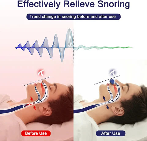 Mikro-CPAP Schlafapnoe-Gerät für Reisen & gegen Schnarchen - CPAP-Alternative