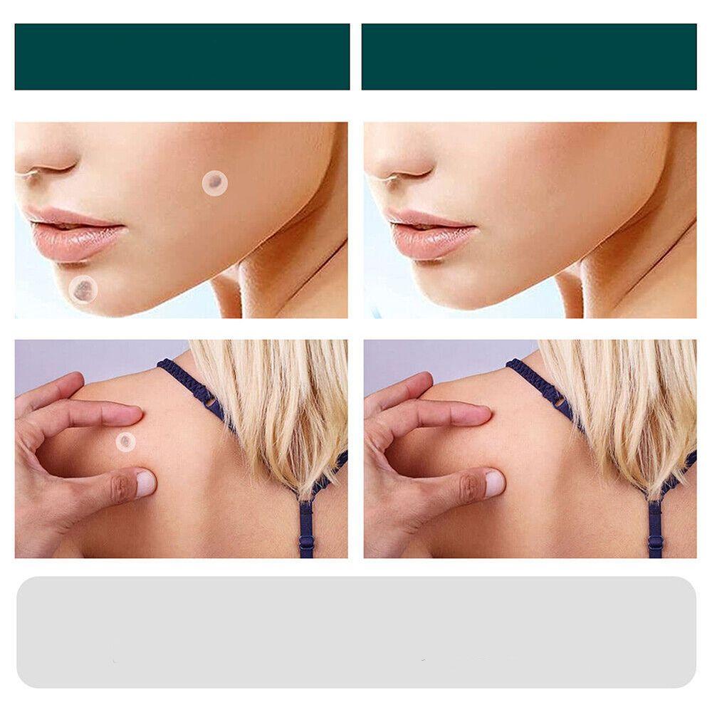 Ripob | SkinClear Hautwarzenentferner | Pflaster zur Entfernung von Hautwarzen & Warzen | Hydrocolloid-Technologie | Schmerzfrei & Diskret | Für alle Hauttypen geeignet | 144 Stück