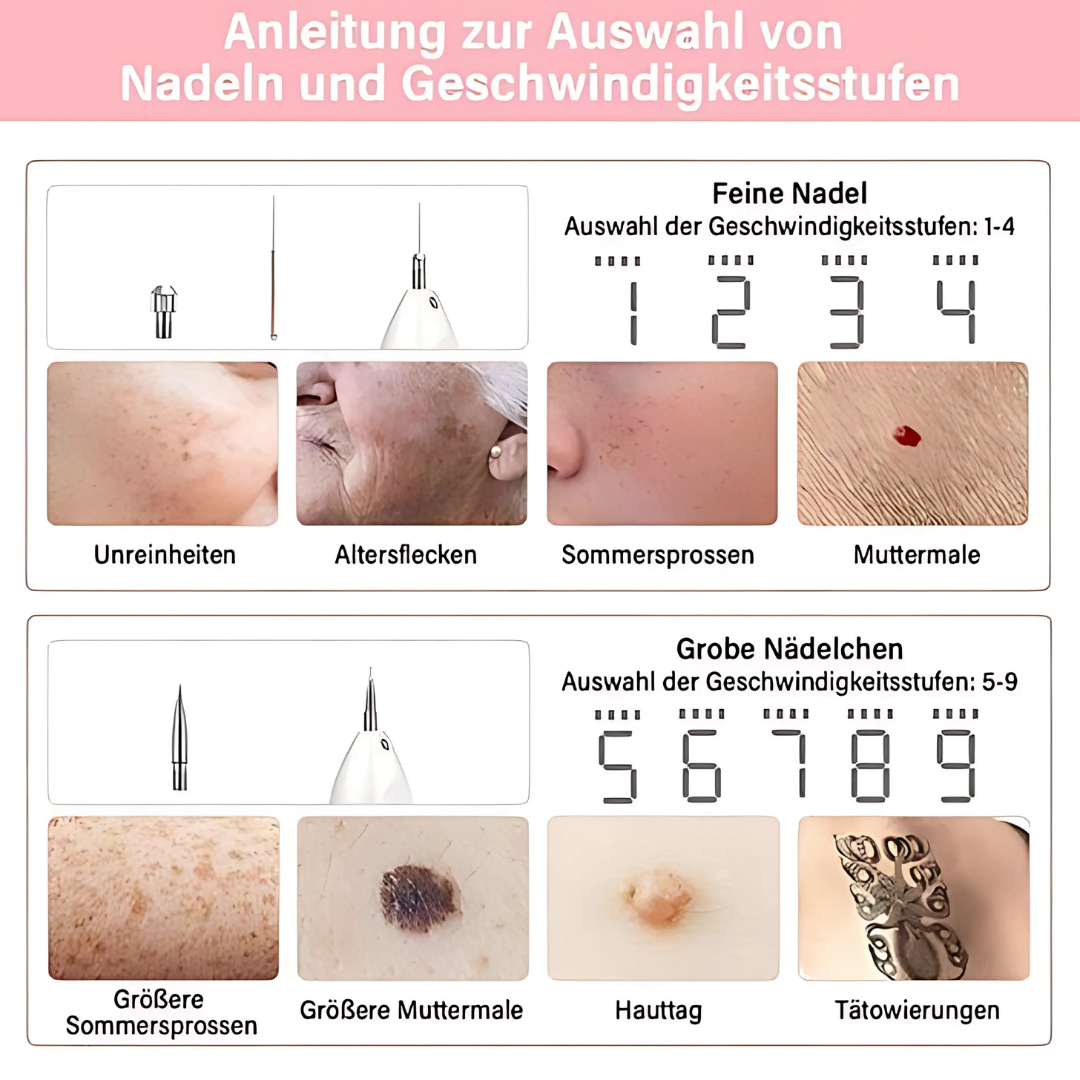 Plasma-Stift zur sicheren Entfernung von Hautmakeln